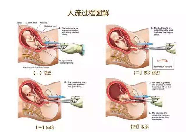 求你们别再捧无痛人流了！男人都做好安全措施！-恋爱撩妹网-聊天话术|脱单方法|约会技巧|哄女生|牵手探探微信聊天案例|
